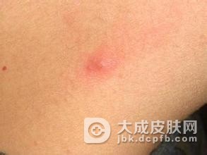 艾滋病的3大传播途径