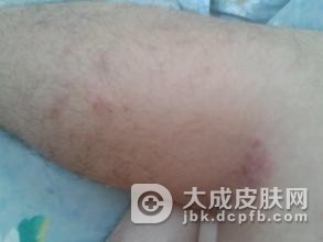 艾滋病的两大传播方法