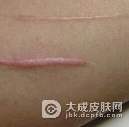 面部疤痕的护理措施