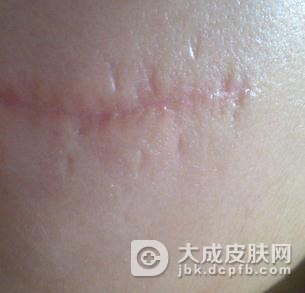 疤痕疙瘩患者该如何饮食