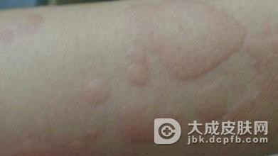 慢性荨麻疹是怎么得的