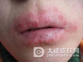 面部干性湿疹有什么症状