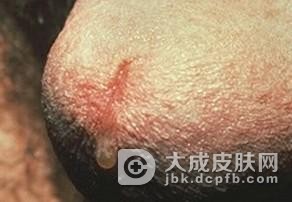 男性患上淋病会发生哪些迹象