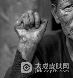寻找麻风病的发病原因