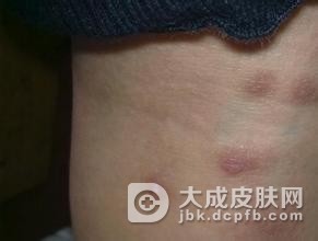 感染疥疮的途径都有什么呢