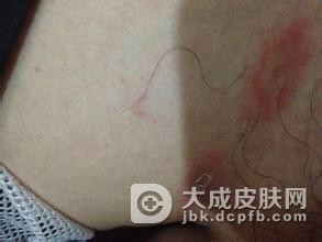 疥疮的间接传染途径是什么呢