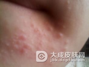 粉刺皮肤的八大护理方法