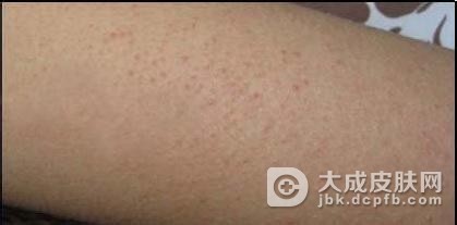 产生毛囊角化的病因有哪些