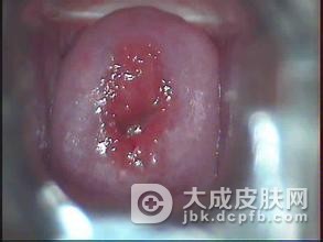 宫颈糜烂会不会引发宫颈癌的出现
