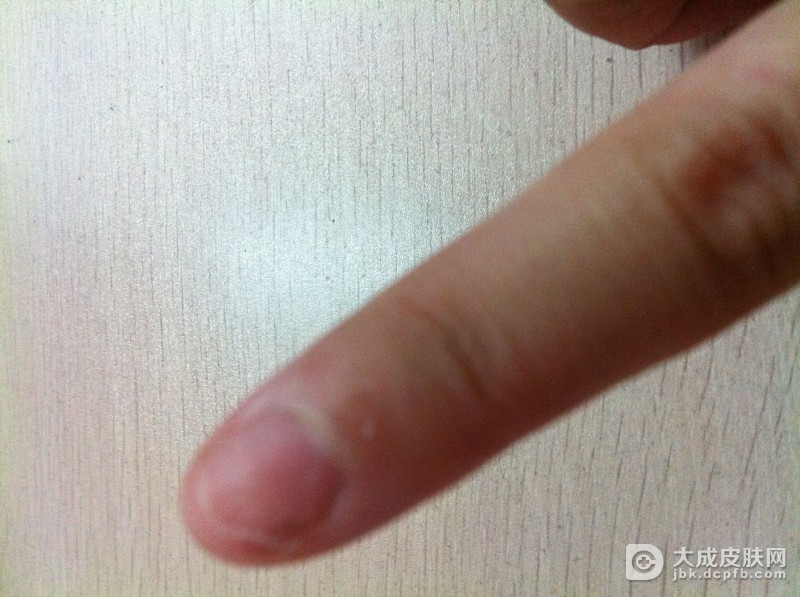甲癣病发后会有的症状是什么？