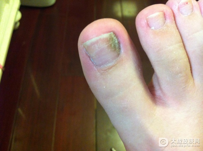 甲癣患者需要注意哪些事项