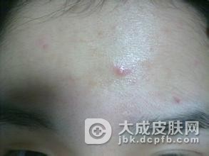 中医治疗毛囊角化病