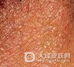 皮肤瘙痒症怎么处理好