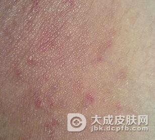 皮肤瘙痒症吃什么药好呢