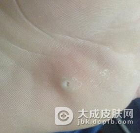 鸡眼要注意什么