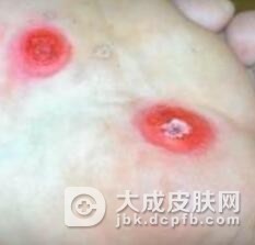 鸡眼该怎么预防