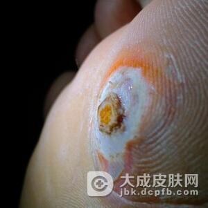 鸡眼怎么治才有效果