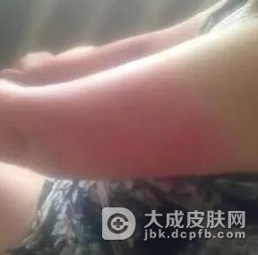 日光性皮炎会传染给别人吗