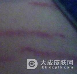 萎缩纹的混淆疾病