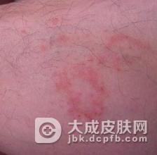 传染性湿疹样皮炎的症状表现具体是什么