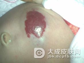 混合型血管瘤是什么病