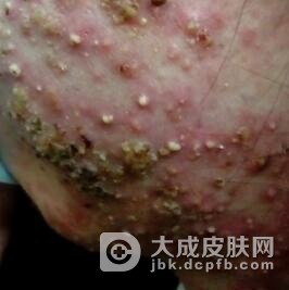 糠秕孢子菌毛囊炎应如何诊断