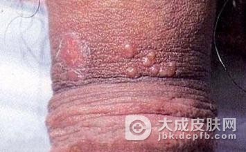 三期梅毒(晚期梅毒)的症状