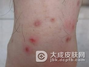 三期梅毒的5大症状特点