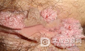 三期梅毒患者多吃些什么比较好呢