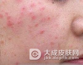 患者咨询脂溢性皮炎怎样预防