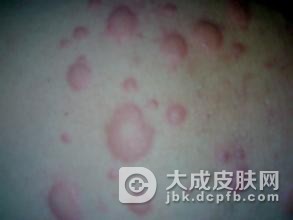 生活中如何预防荨麻疹的出现呢
