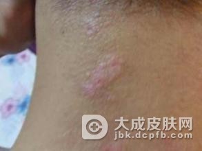 过敏性皮炎的预防事项该怎么做