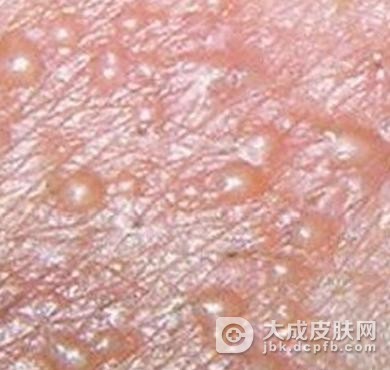 生殖器疱疹的病因都有什么