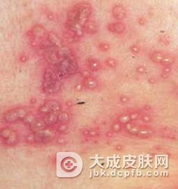 生殖器疱疹的诱因是什么