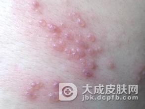 生殖器疱疹医治后复发怎么办