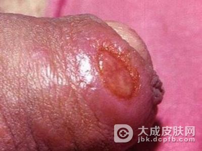 梅毒能治好吗