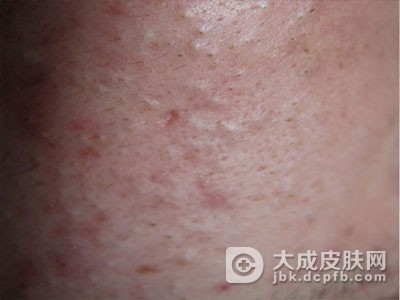 甲沟炎疾病具体分为哪些类型