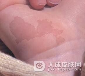 咖啡斑治疗后该如何护理