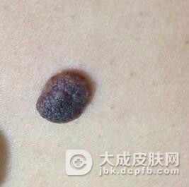黑色素瘤的临床表现有什么