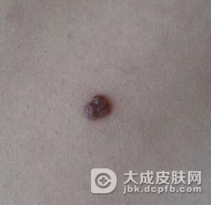 黑色素瘤患者的饮食护理有哪些呢
