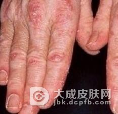 皮肌炎是什么病的认知