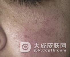 皮肌炎的症状包括哪些呢