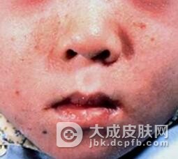 急性型皮肌炎的治疗方法