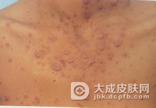 药疹主要有哪些临床表现