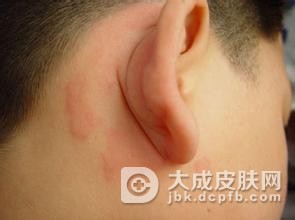 药疹的常见症状