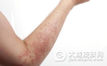 固定性药疹患者需如何护理