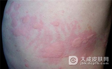 风疹块是什么