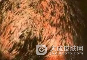 如何应对头癣的传染