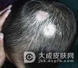 哪种头癣会引发永久性秃发
