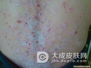 治疗银屑病期间有什么注意事项呢